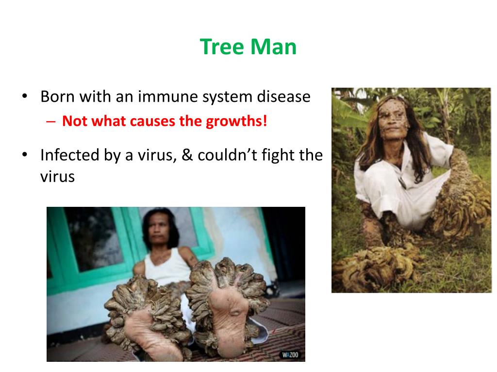 tree man syndrome removal