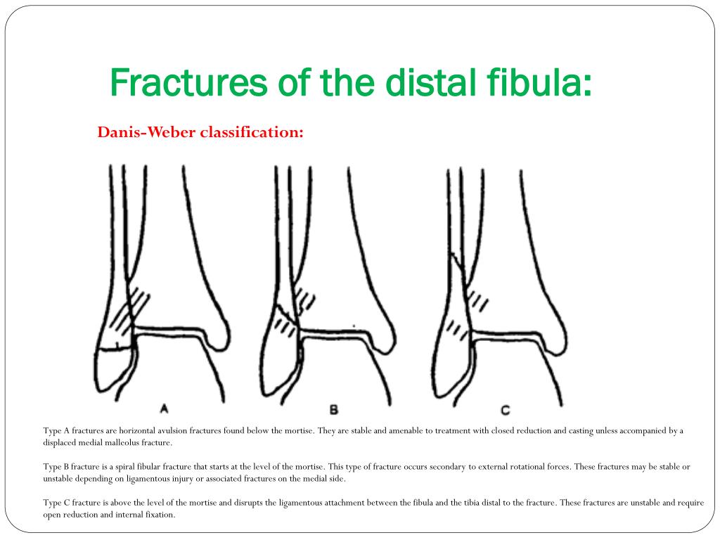 icd 10 code for weber b distal fibula fracture