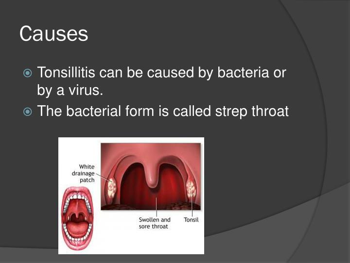 PPT Tonsillitis PowerPoint Presentation ID2152221