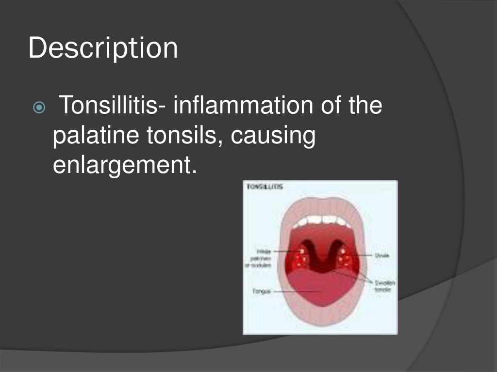 Ppt Tonsillitis Powerpoint Presentation Free Download Id2152221