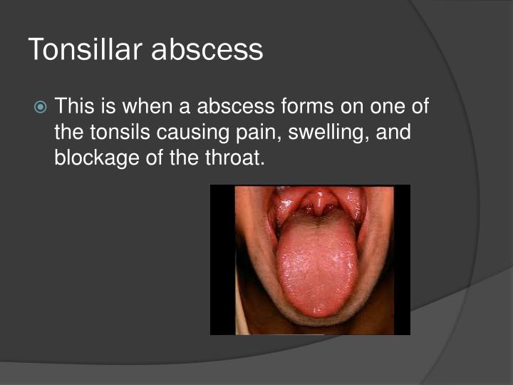 PPT Tonsillitis PowerPoint Presentation ID2152221