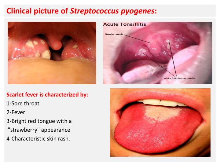 cancer nystatin swish esophageal thrush cancer nystatin swish esophageal thrush