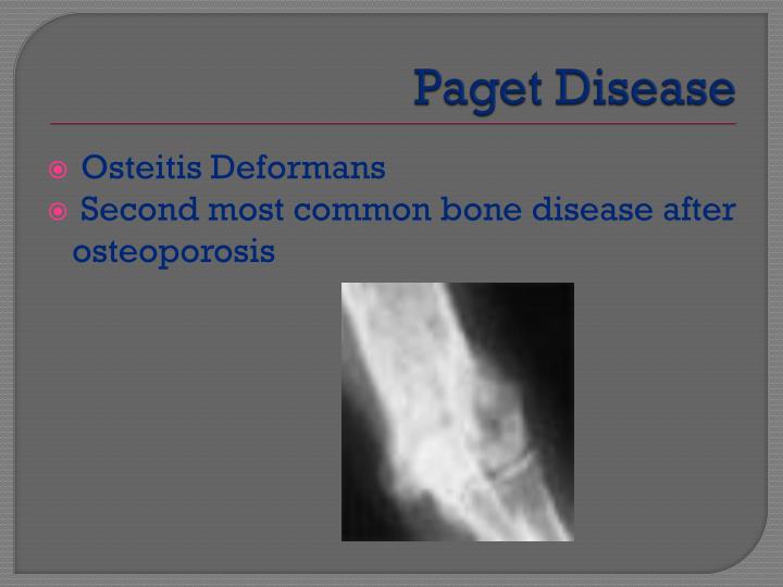 PPT - Paget Disease PowerPoint Presentation - ID:2153842