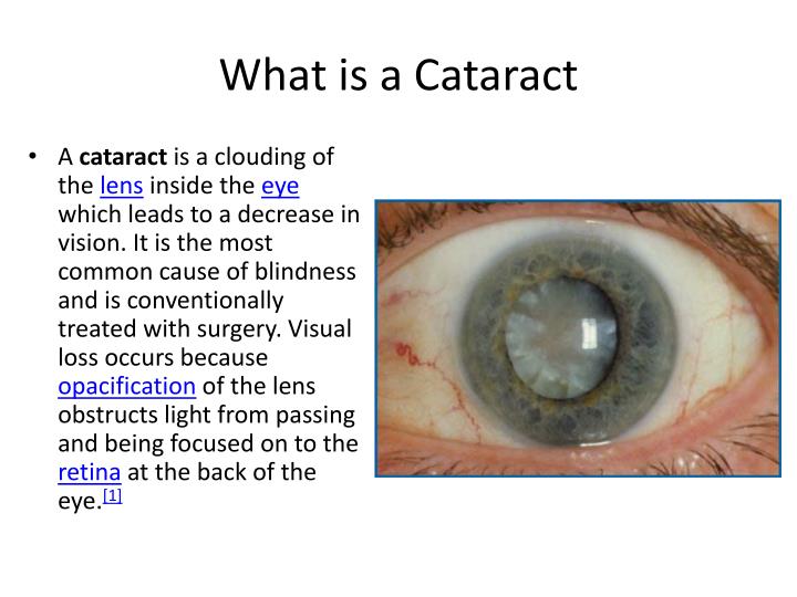 PPT Cataract Surgery & Premium IOLs PowerPoint Presentation ID2155016