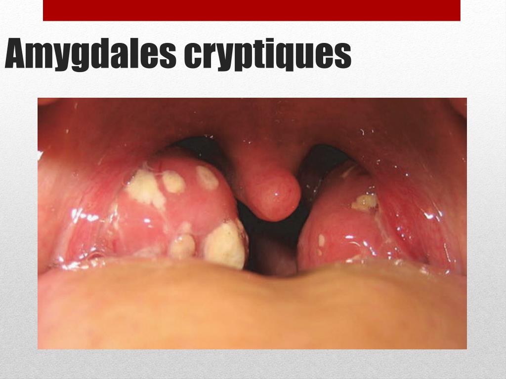 PPT - Amygdales cryptiques PowerPoint Presentation, free download ...