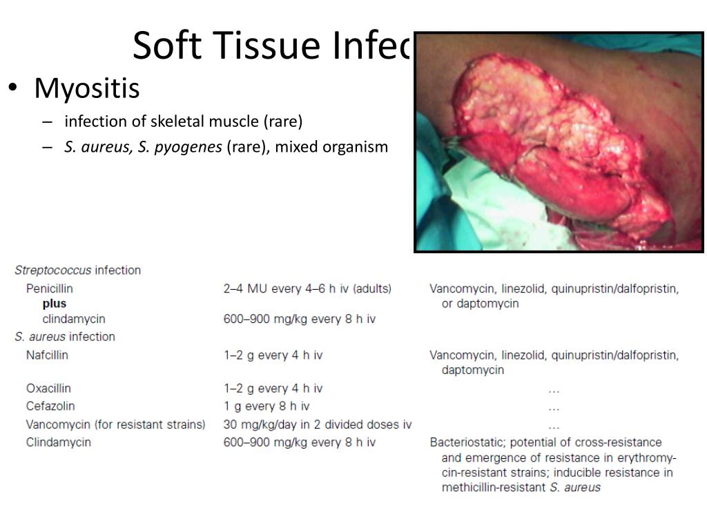 throat Deep infection tissue