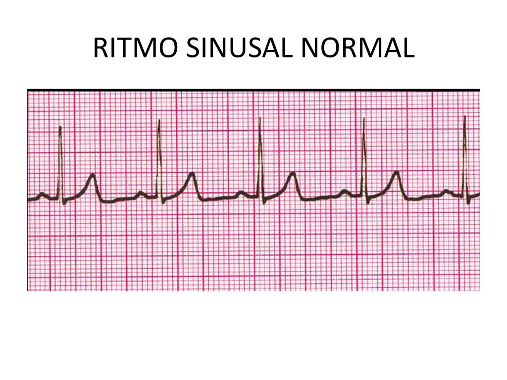 Ritmo Sinusal Normal Ritmo Sinusal Normal