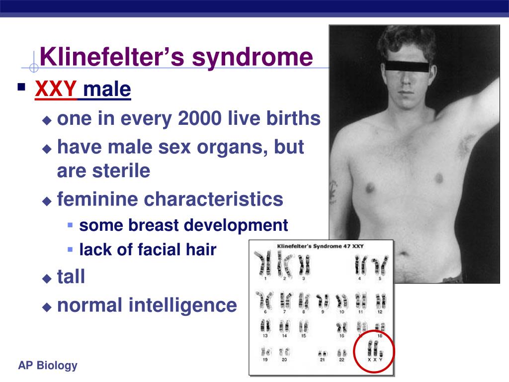 Xxy хромосома. Клайнфельтера синдром Клайнфельтера. Синдромы болезни Клайнфельтера. Клайнфельтера хромосомы. Синдром Клайнфельтера 47 xxy.