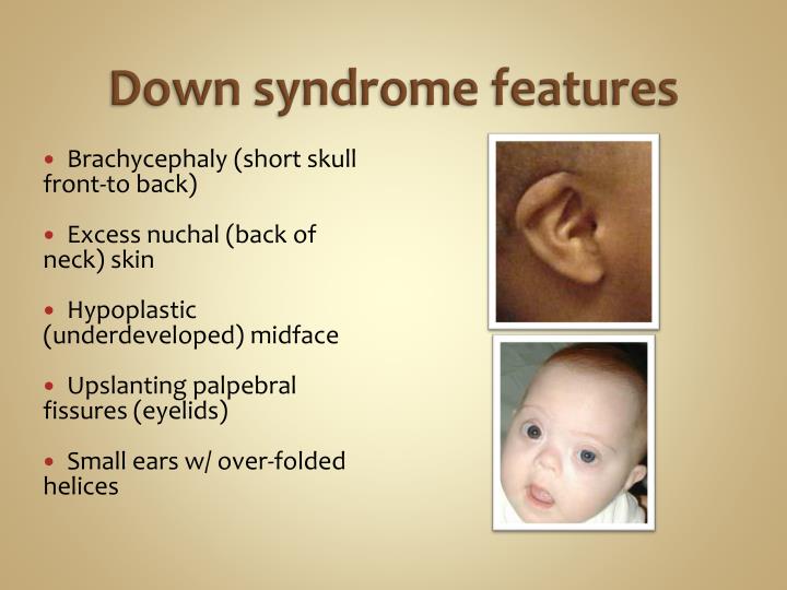 down syndrome features