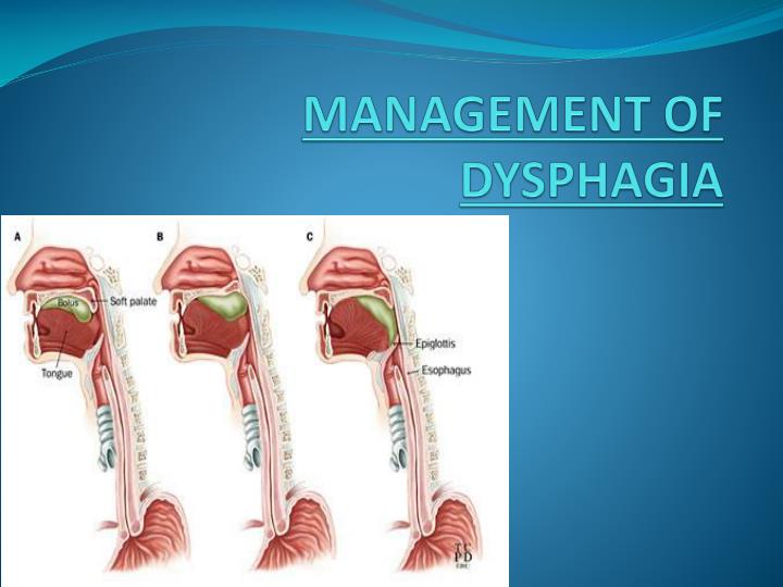 PPT - MANAGEMENT OF DYSPHAGIA PowerPoint Presentation - ID:2170856