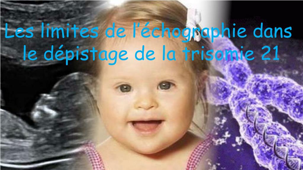 Ppt Les Limites De L Echographie Dans Le Depistage De La Trisomie 21 Powerpoint Presentation Id Ppt Les Limites De L Echographie Dans Le Depistage De La Trisomie 21 Powerpoint Presentation Id