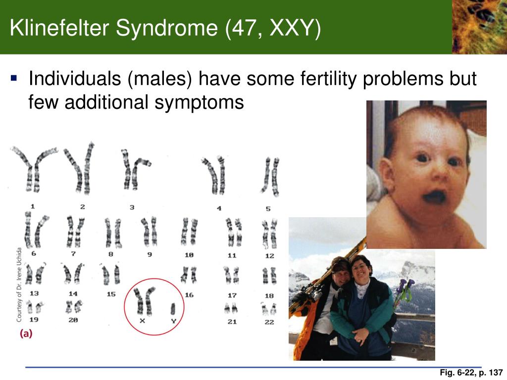 Xxy хромосома. Синдром Клайнфельтера 47 xxy. Клайнфельтер хромосомы. Xxy синдром Клайнфельтера.