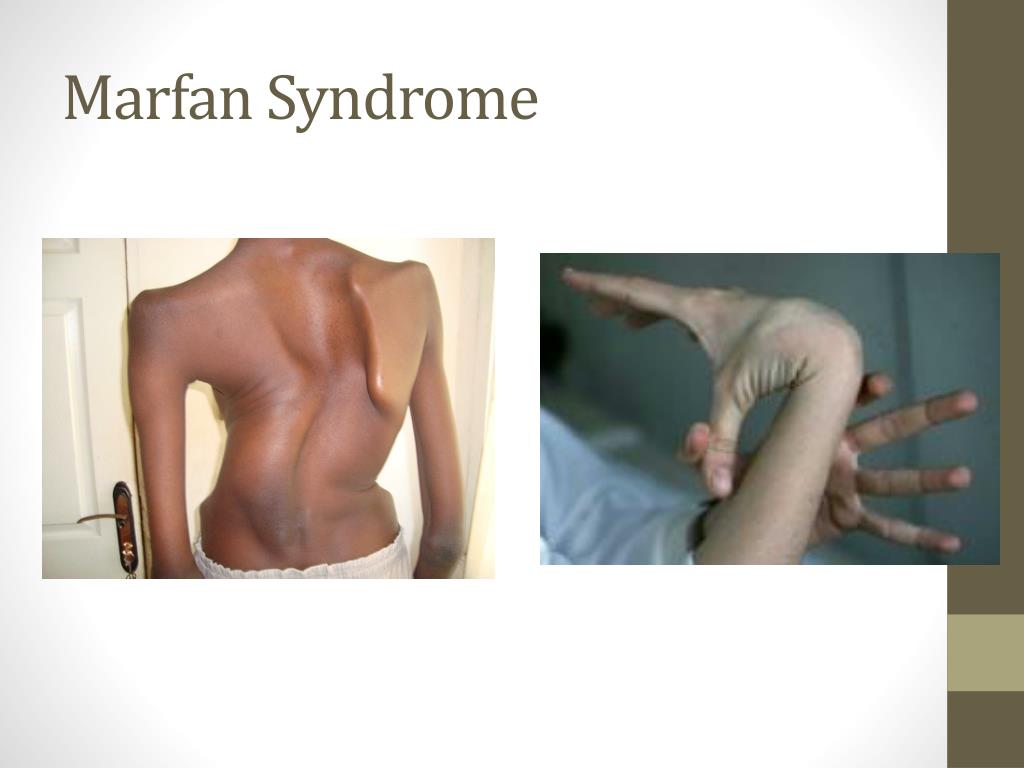 PPT - Marfan Syndrome PowerPoint Presentation, free download - ID:2171771