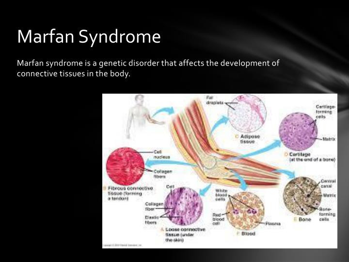 PPT - Marfan Syndrome PowerPoint Presentation - ID:2171812