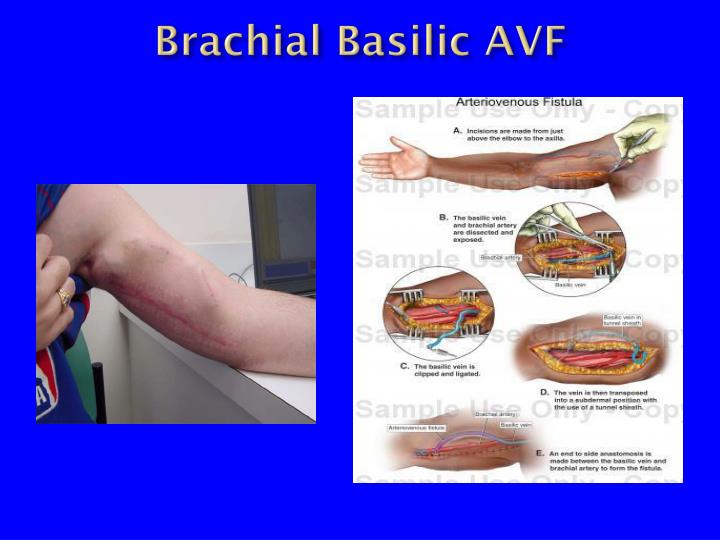 Basilic And Brachial Vein