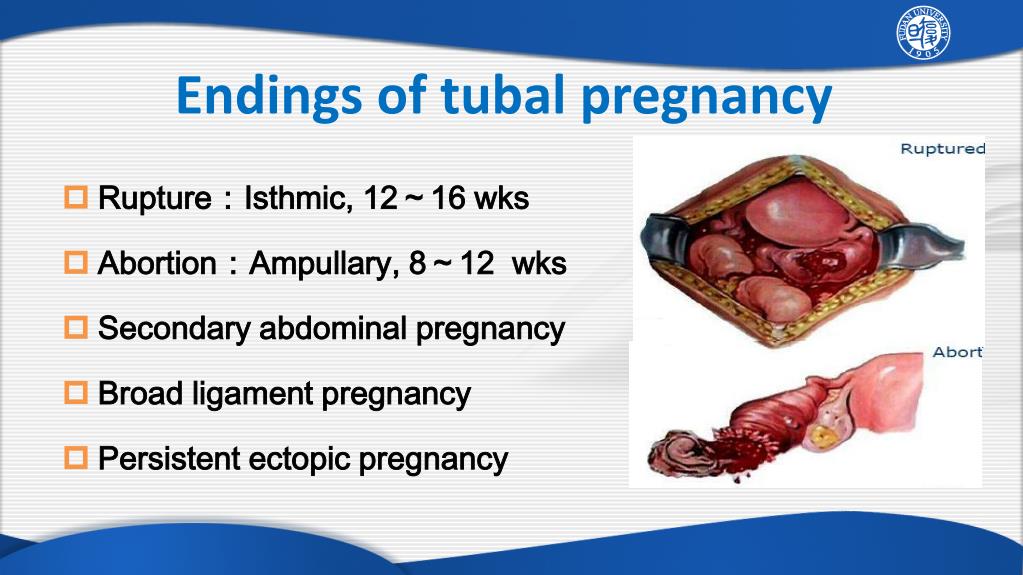 clinical presentation of tubal pregnancy