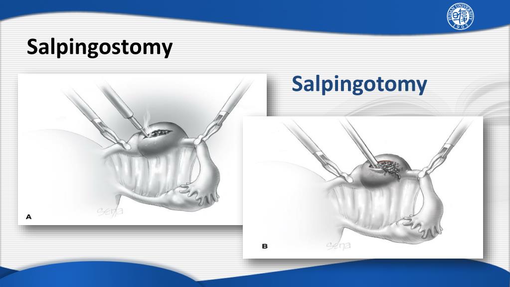 Ppt Ectopic Pregnancy Powerpoint Presentation Free Download Id2176500 2901