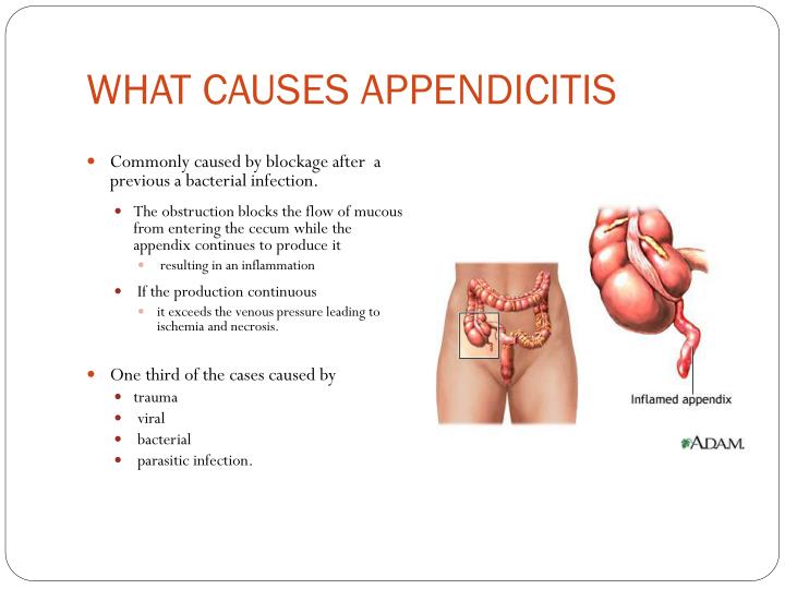 PPT APPENDICITIS PowerPoint Presentation ID2176545