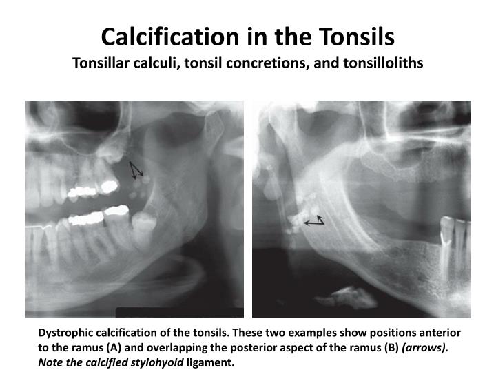ppt soft tissue calcification and ossification palatine tonsils