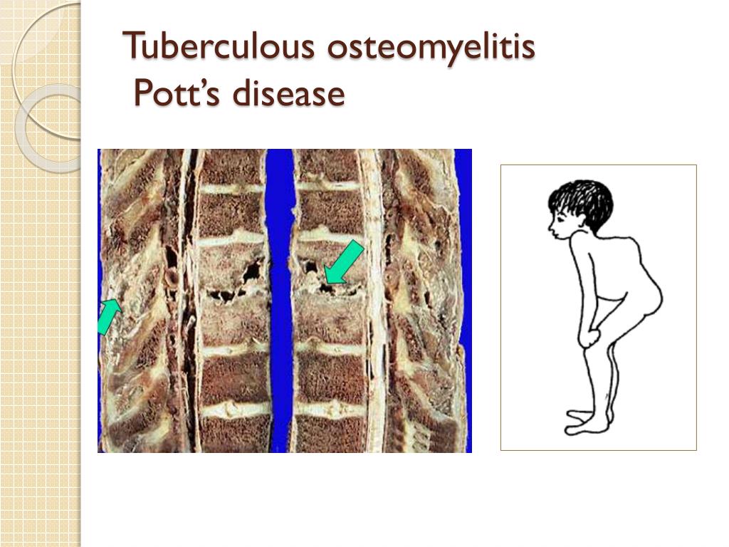 PPT MUSCULOSKELETAL BLOCK Pathology OSTEOMYELITIS and SEPTIC