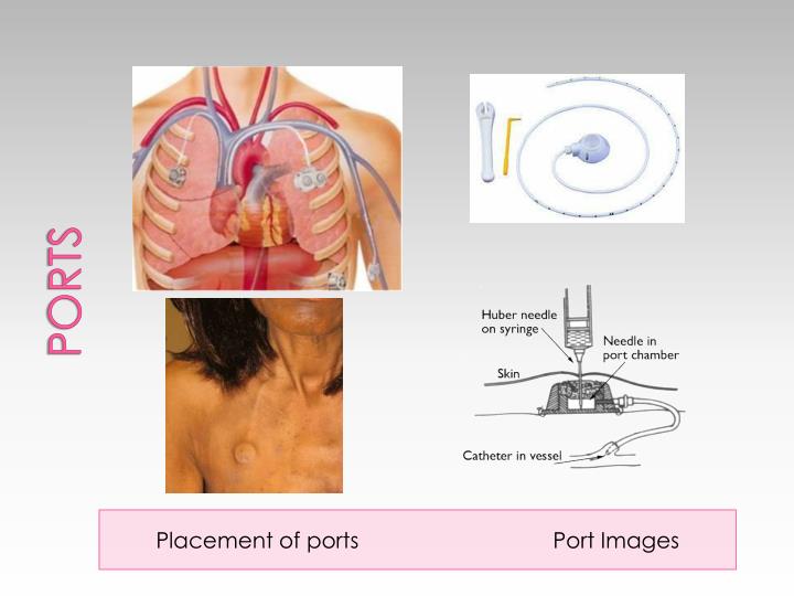 PPT VASCULAR ACCESS DEVICES PowerPoint Presentation ID2179111