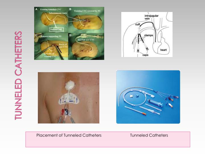 PPT VASCULAR ACCESS DEVICES PowerPoint Presentation ID2179111