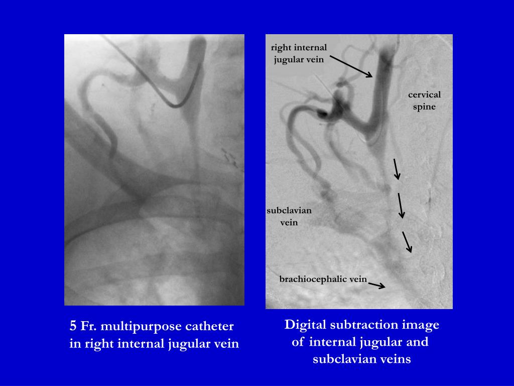 PPT 5 Fr. multipurpose catheter in right internal jugular vein