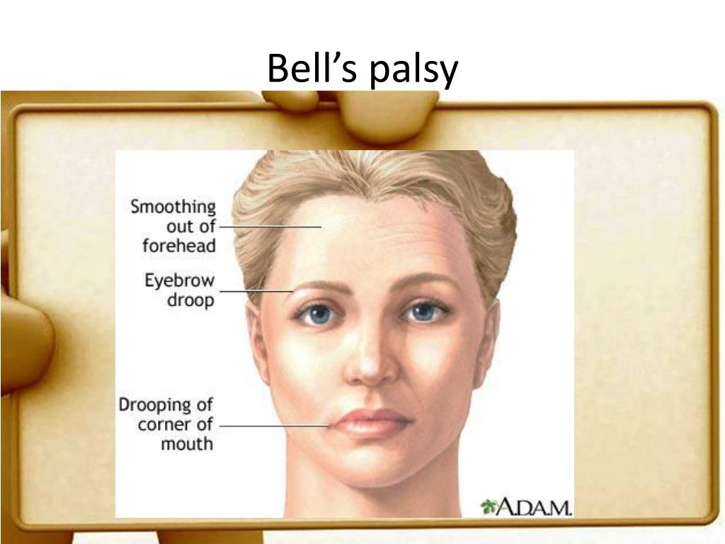 PPT - Bell’s Palsy PowerPoint Presentation, free download - ID:2184905