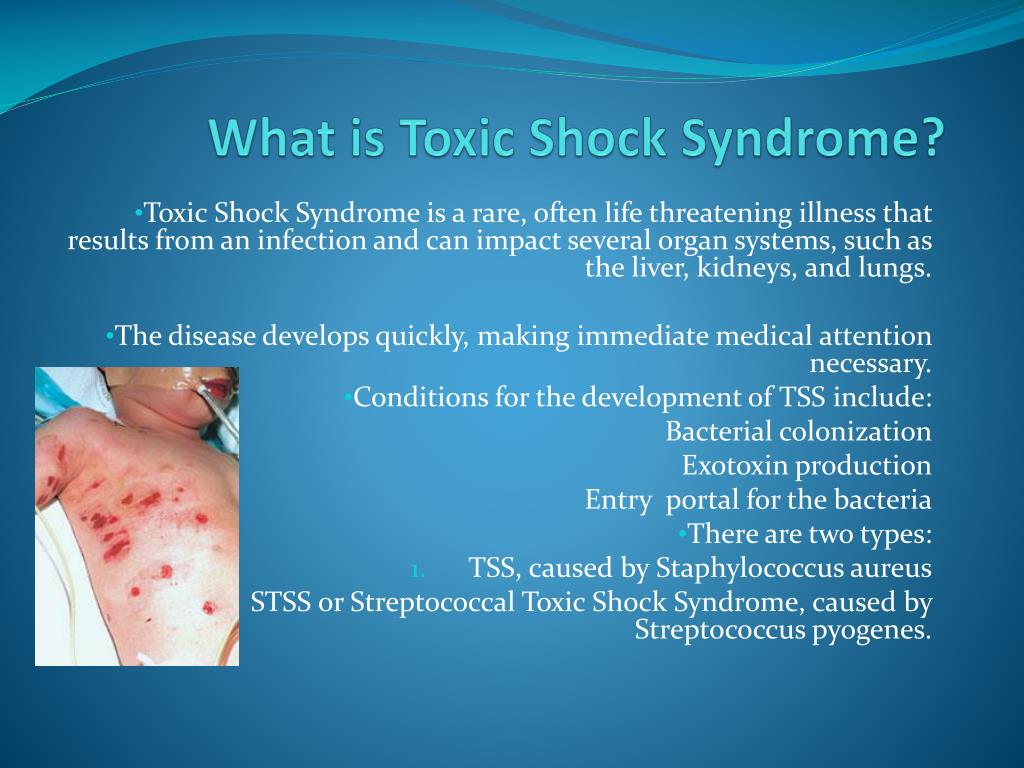 Three facts about toxic shock syndrome - Vuokkoset