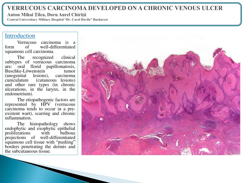 The Spectrum Of Oral Lesions Presenting Clinically With Papillary