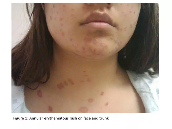 PPT - Figure 1: Annular erythematous rash on face and trunk PowerPoint ...