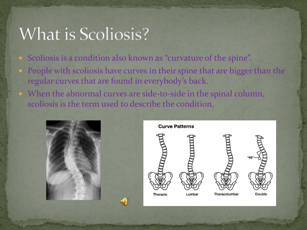 PPT - Scoliosis PowerPoint Presentation, Free Download - ID:2202938