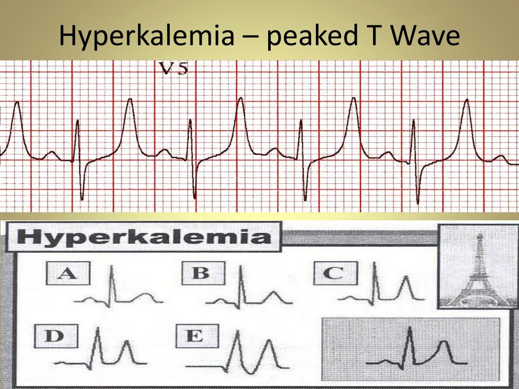 peaked t waves in hyperkalemia peaked t waves in hyperkalemia