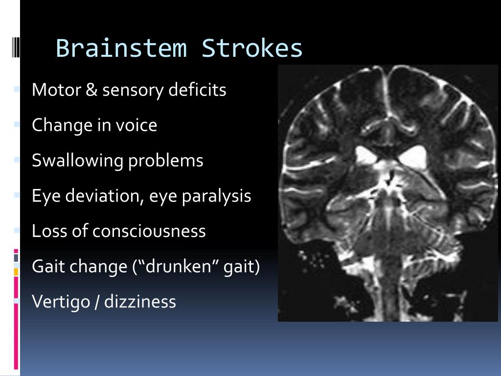 brain stem stroke recovery