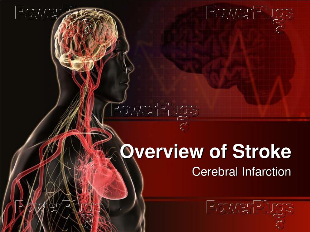 presentation about stroke