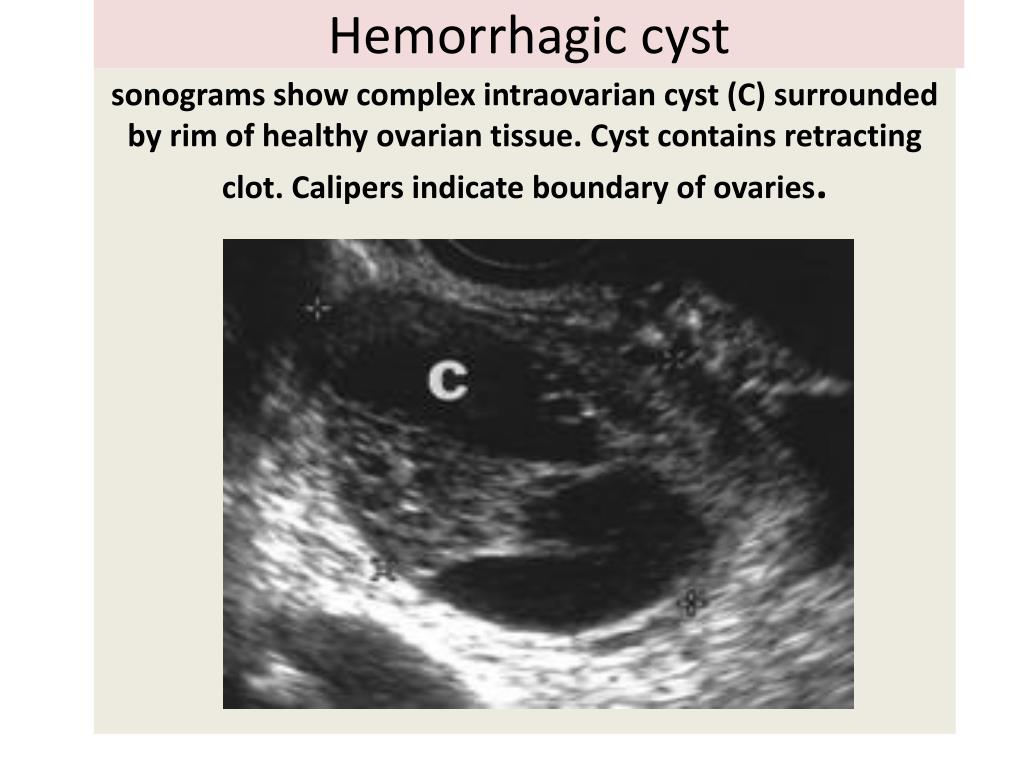 PPT Malignant Diseases Of The Uterus PowerPoint Presentation Free PPT Malignant Diseases Of The Uterus PowerPoint Presentation Free