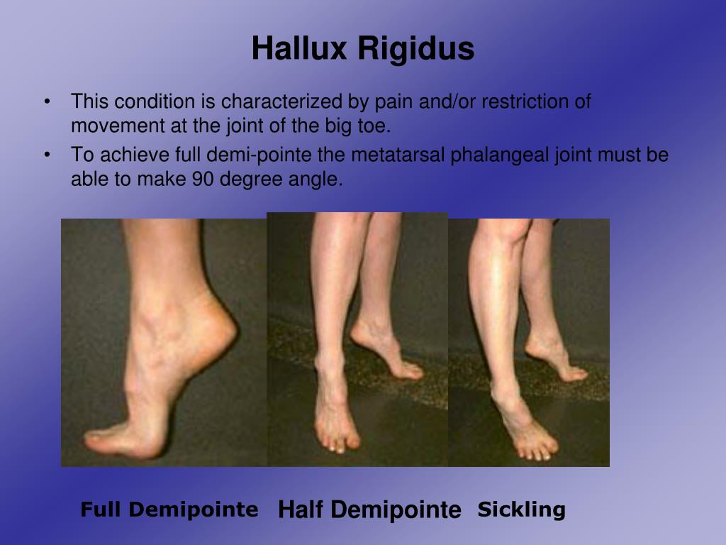 PPT - Injury Awareness And Prevention For Dancers PowerPoint ...