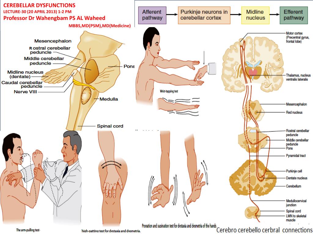 What Is Dysmetria? How Does This Brain Condition Affect Movement Of Your  Body | Onlymyhealth