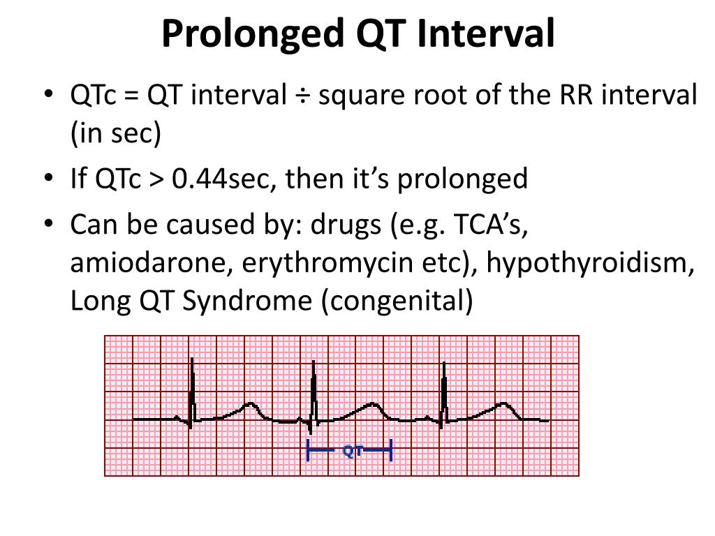 PPT ECGs PowerPoint Presentation Free Download ID 2225958