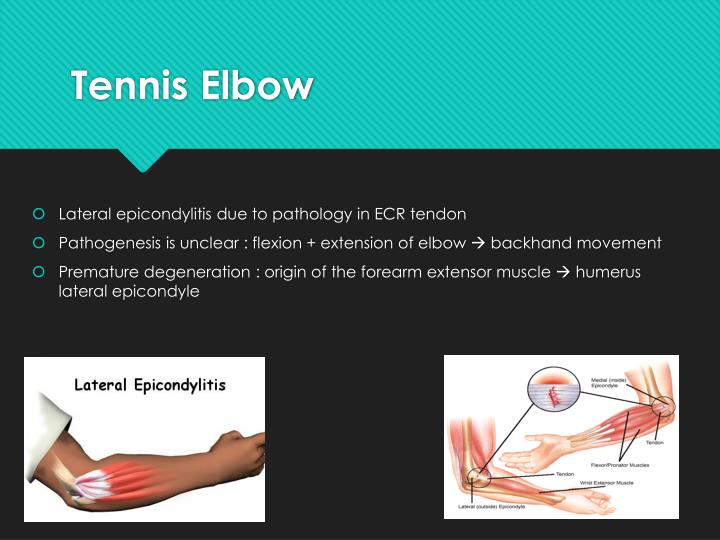 PPT Degenerative Tendon Disease of The Elbow & Hand PowerPoint