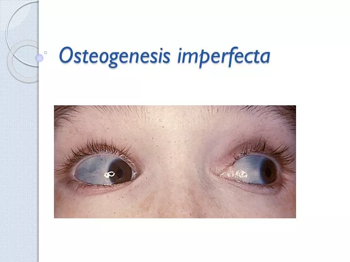 clinical description of osteogenisis imperfecta oi Osteogenesis imperfecta (oi) is a group of inherited genetic disorders with a wide range of clinical heterogeneity bone fragility is the cardinal feature of. clinical description of osteogenisis imperfecta oi Osteogenesis imperfecta (oi) is a group of inherited genetic disorders with a wide range of clinical heterogeneity bone fragility is the cardinal feature of.