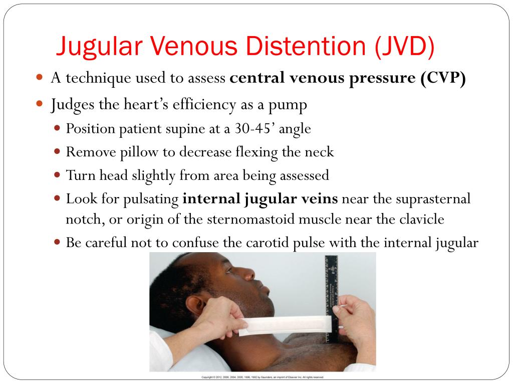 Jugular Venous Pressure Causes
