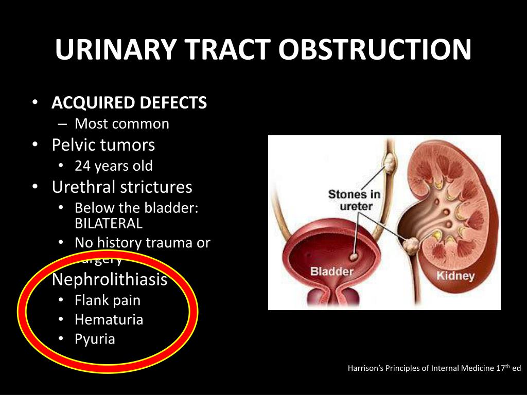 Fairbanks Urology - Most common causes of Flank Pain- Flank pain is often  caused by urinary tract infections, kidney stones, and musculoskeletal pain.  Flank pain most commonly results from one of three