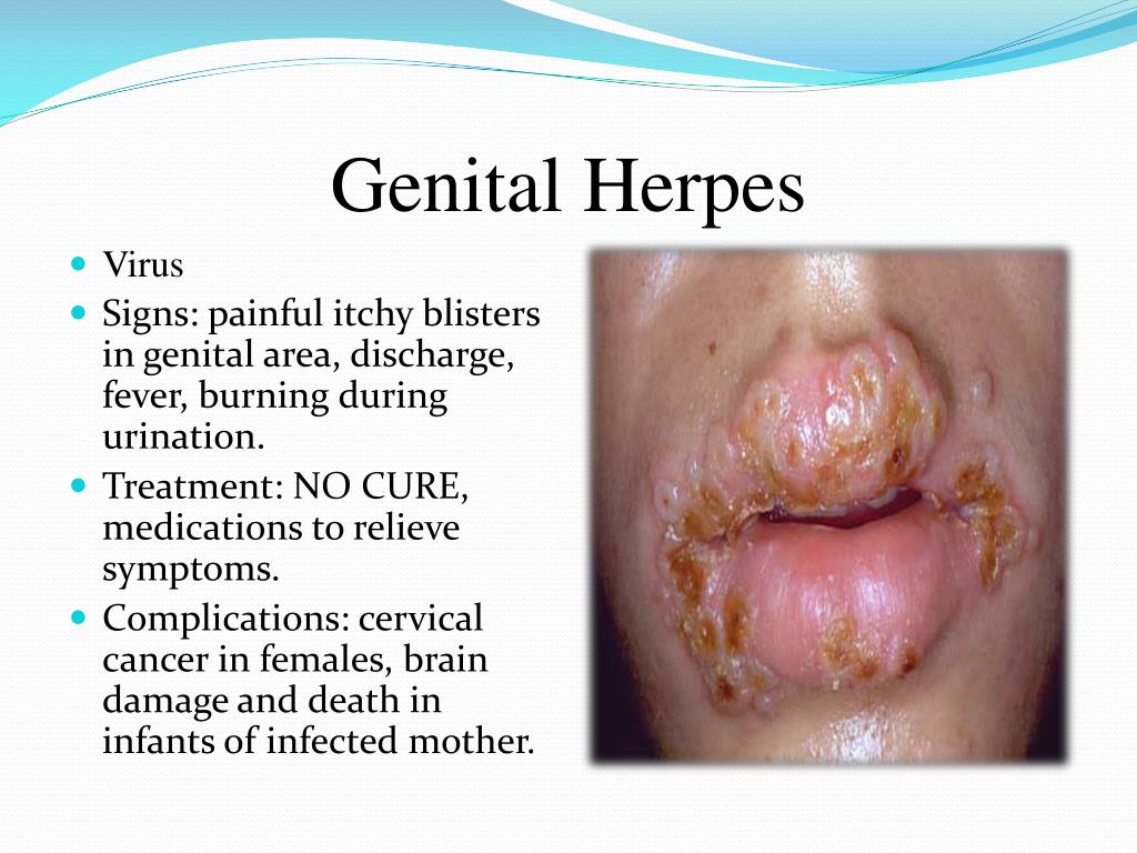 genital herpes.