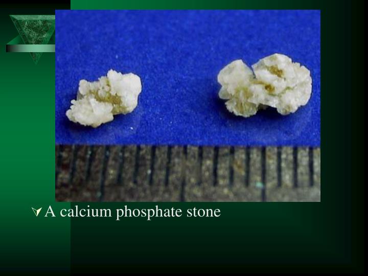PPT Renal Stone PowerPoint Presentation ID2241273