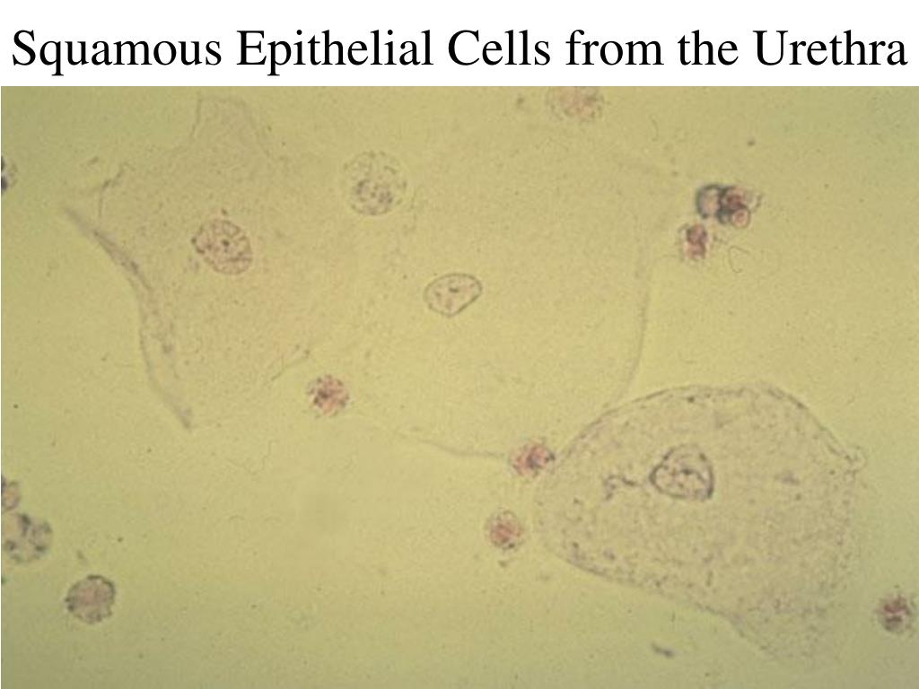 Повышенный эпителий в моче у мужчин. Микроскопия мочи эпителий плоский. Микроскопия осадка мочи почечный эпителий. Плоский эпителий в моче микроскопия. Клетки почечного эпителия норма.