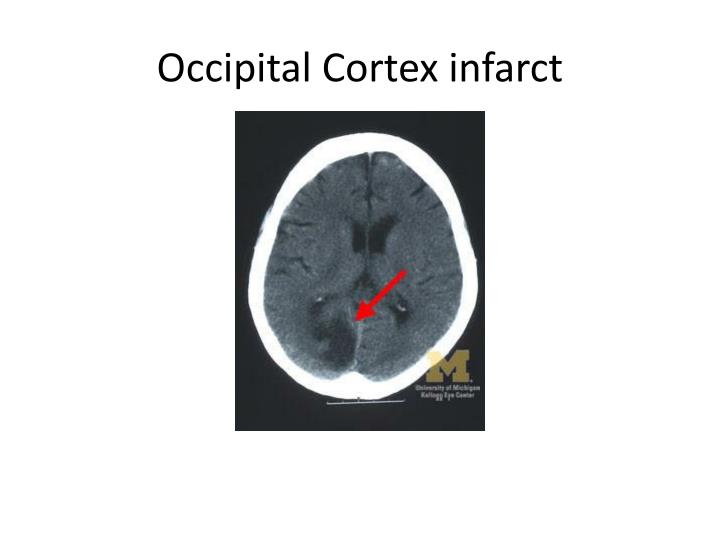 PPT - Acute Vision Loss No laughing matter… PowerPoint Presentation ...