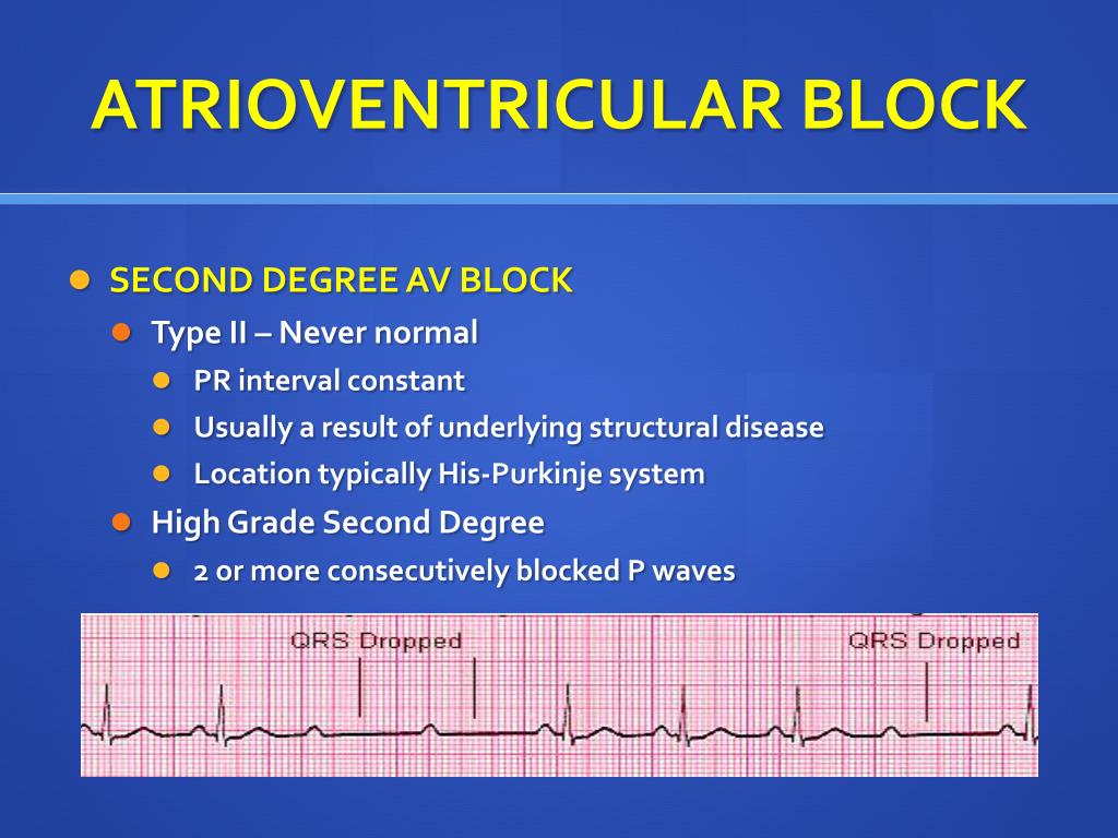 Av блок. Atrioventricular Block. Av Block. Pacemaker av Block. ECG av Block 3.