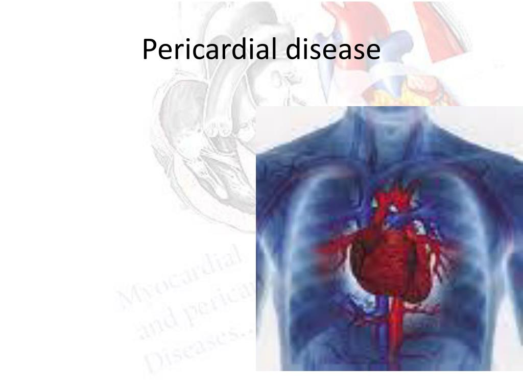 PPT - Diagnostic approach of valvular myocardial and pericardial ...