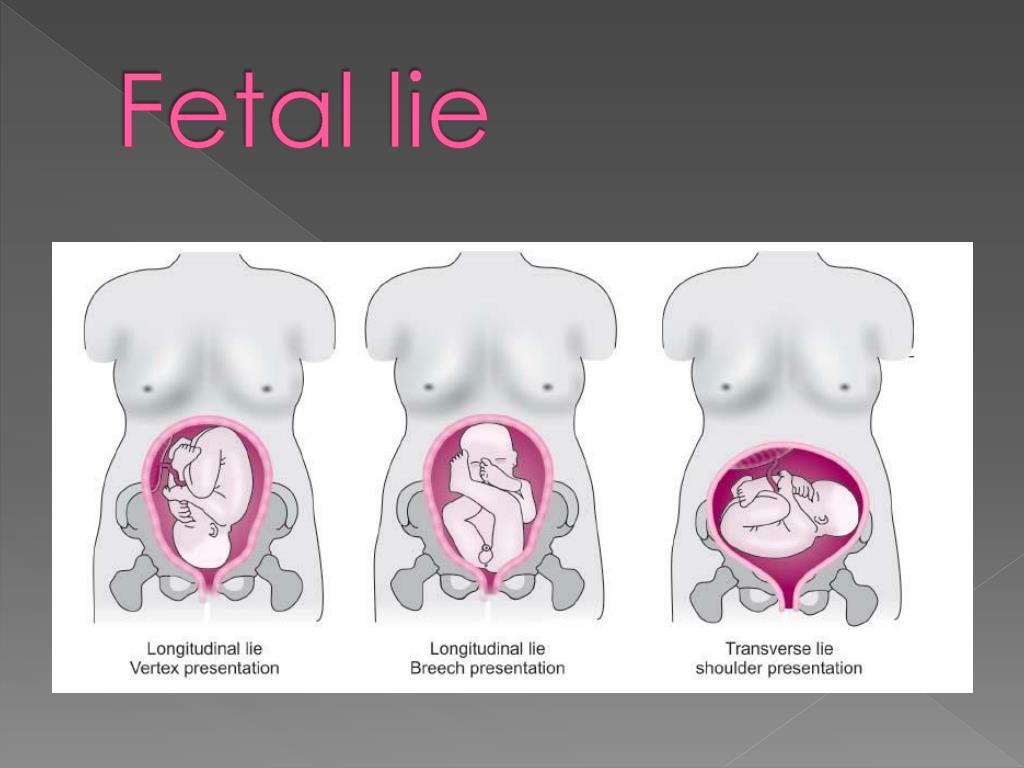 fetal lie is longitudinal with cephalic presentation in hindi